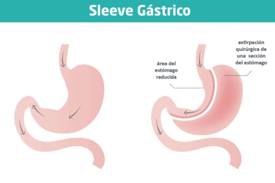 Tratamiento Quirúrgico de la Obesidad